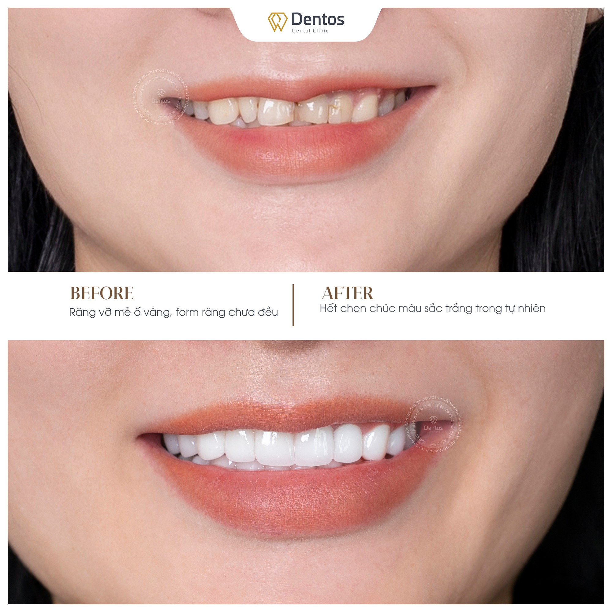 Khách hàng tự tin cười rạng rỡ sau khi bọc răng sứ thẩm mỹ 1 hàm